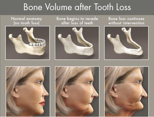 tooth loss leads to bone loss